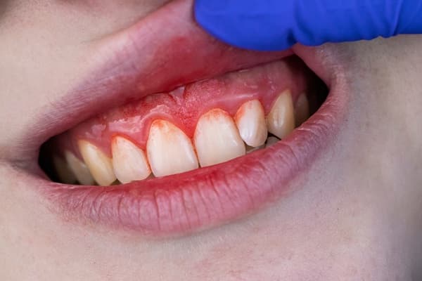 Periodontic Treatment in Bikaner: Complete Care for Healthy Gums and Strong Teeth